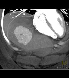 Focal Nodular Hyperplasia (FNH) With Central Scar and Feeding Vessel - CTisus CT Scan