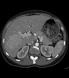 Focal Nodular Hyperplasia (FNH) Becomes Isodense on Delayed Phase Image - CTisus CT Scan