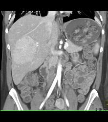 Focal Nodular Hyperplasia (FNH) Becomes Isodense on Delayed Phase Image - CTisus CT Scan