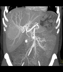 Focal Nodular Hyperplasia (FNH) Becomes Isodense on Delayed Phase Image - CTisus CT Scan