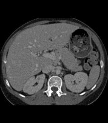 Focal Nodular Hyperplasia (FNH) Becomes Isodense on Delayed Phase Image - CTisus CT Scan