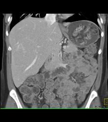 Focal Nodular Hyperplasia (FNH) Becomes Isodense on Delayed Phase Image - CTisus CT Scan