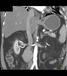 Neuroendocrine Tumor With Liver Metastases - CTisus CT Scan