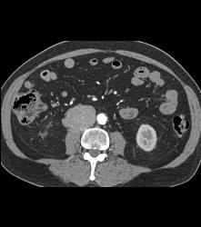 Neuroendocrine Tumor With Liver Metastases - CTisus CT Scan