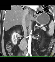 Neuroendocrine Tumor With Liver Metastases - CTisus CT Scan