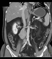 Neuroendocrine Tumor With Liver Metastases - CTisus CT Scan