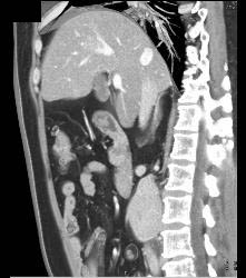 Neuroendocrine Tumor With Liver Metastases - CTisus CT Scan