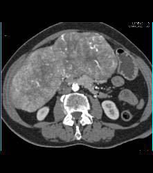 Hepatocellular Carcinoma (Hepatoma) With Central Scar and Neovascularity - CTisus CT Scan