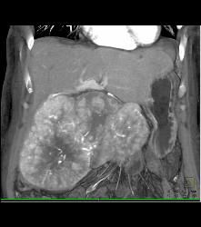 Hepatocellular Carcinoma (Hepatoma) With Central Scar and Neovascularity - CTisus CT Scan