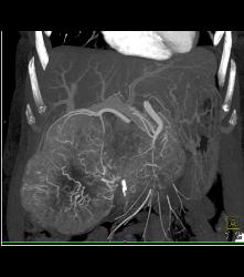 Hepatocellular Carcinoma (Hepatoma) With Central Scar and Neovascularity - CTisus CT Scan