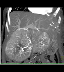 Hepatocellular Carcinoma (Hepatoma) With Central Scar and Neovascularity - CTisus CT Scan