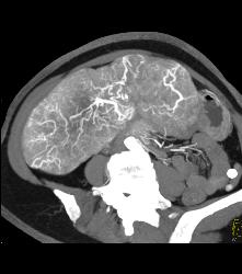 Hepatocellular Carcinoma (Hepatoma) With Central Scar and Neovascularity - CTisus CT Scan