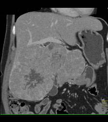 Hepatocellular Carcinoma (Hepatoma) With Central Scar and Neovascularity - CTisus CT Scan