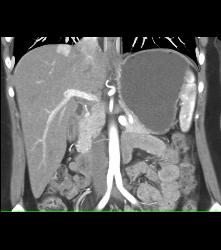 Focal Nodular Hyperplasia (FNH) - CTisus CT Scan