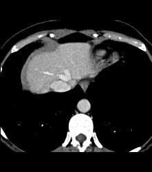 Focal Nodular Hyperplasia (FNH) - CTisus CT Scan