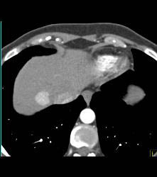 Focal Nodular Hyperplasia (FNH) - CTisus CT Scan