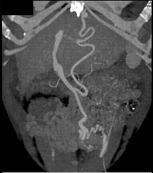 Recanalized Umbilical Vein in Cirrhotic Patient - CTisus CT Scan