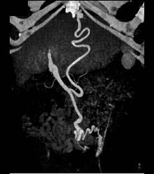 Recanalized Umbilical Vein in Cirrhotic Patient - CTisus CT Scan