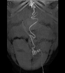 Recanalized Umbilical Vein in Cirrhotic Patient - CTisus CT Scan