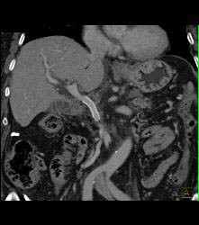 Portal Vein Stent That Is Patent But Minimally Narrowing Distally At Vessel Junction- See Full Sequence - CTisus CT Scan