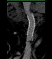 Portal Vein Stent That Is Patent But Minimally Narrowing Distally At Vessel Junction- See Full Sequence - CTisus CT Scan