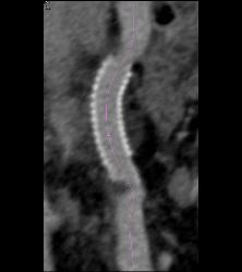 Portal Vein Stent That Is Patent But Minimally Narrowing Distally At Vessel Junction- See Full Sequence - CTisus CT Scan