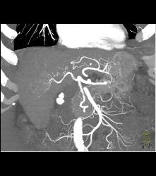 Hepatocellular Carcinoma (Hepatoma) in A Cirrhotic Liver - CTisus CT Scan