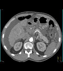 Hepatocellular Carcinoma (Hepatoma) in A Cirrhotic Liver - CTisus CT Scan