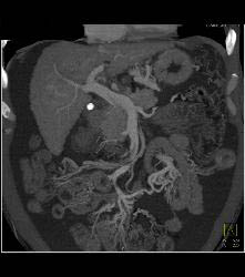 Hepatocellular Carcinoma (Hepatoma) in A Cirrhotic Liver - CTisus CT Scan