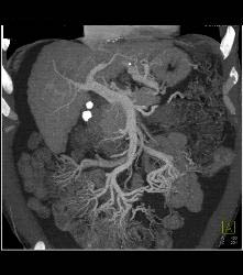 Hepatocellular Carcinoma (Hepatoma) in A Cirrhotic Liver - CTisus CT Scan