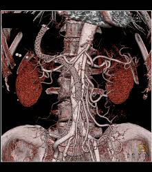 Large Stent in Common Bile Duct (CBD) - CTisus CT Scan