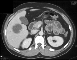 Liver Abscess - CTisus CT Scan