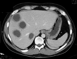 Liver Abscess - CTisus CT Scan