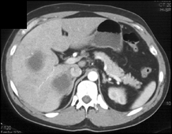 Liver Abscess - CTisus CT Scan