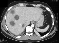 Liver Abscess - CTisus CT Scan