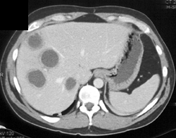 Liver Abscess - CTisus CT Scan