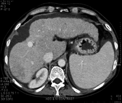 Cirrhosis - CTisus CT Scan