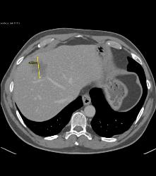 Volumetrics for Metastatic Colon Cancer to Liver - CTisus CT Scan