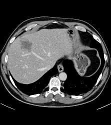 Volumetrics for Metastatic Colon Cancer to Liver - CTisus CT Scan