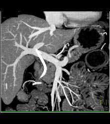 Stent in Common Bile Duct (CBD) - CTisus CT Scan