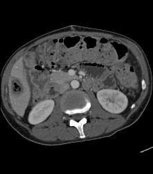 Liver Abscess - CTisus CT Scan