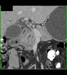 Enhancing Distal Common Bile Duct (CBD) C/w Cholangiocarcinoma - CTisus CT Scan