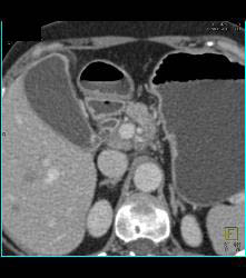 Enhancing Distal Common Bile Duct (CBD) C/w Cholangiocarcinoma - CTisus CT Scan