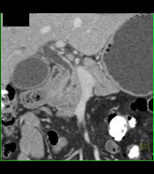 Enhancing Distal Common Bile Duct (CBD) C/w Cholangiocarcinoma - CTisus CT Scan