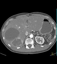 Hepatic Hemangioma Adjacent to A Cyst - CTisus CT Scan