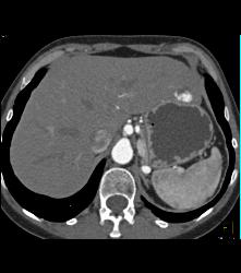 Hemangioma - CTisus CT Scan