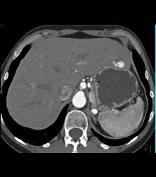 Hemangioma - CTisus CT Scan