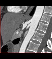 Celiac Artery Aneurysm - CTisus CT Scan