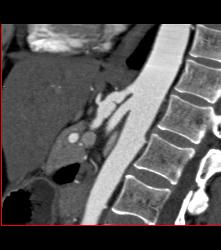 Celiac Artery Aneurysm - CTisus CT Scan