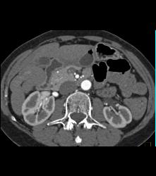 Cirrhosis With Scar - CTisus CT Scan